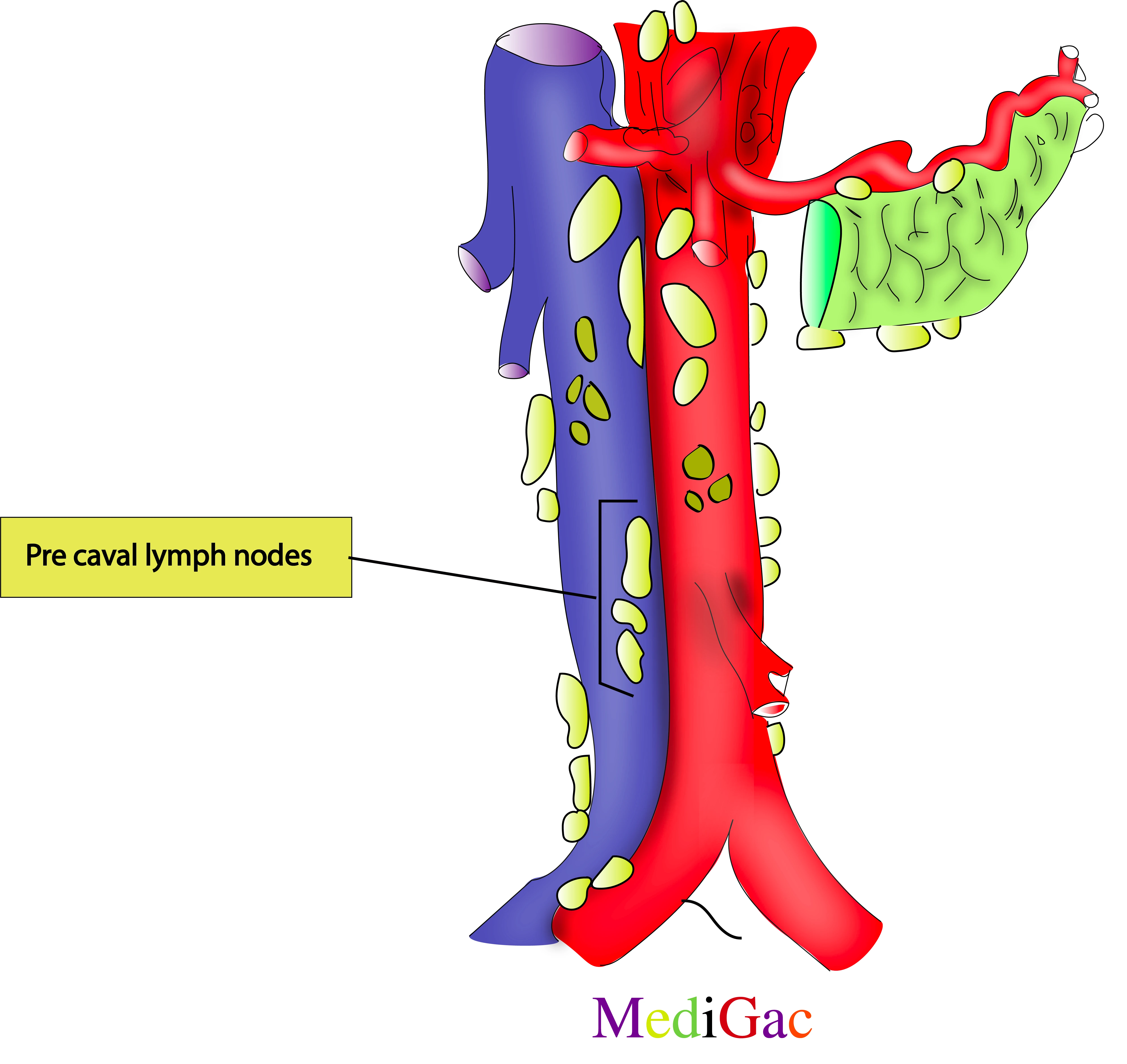 Pre caval lymph nodes